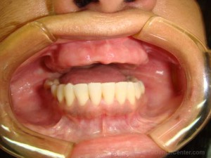 Dental Implants-Before