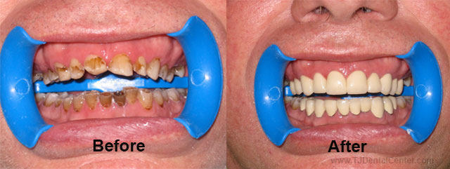 Before-and-After Cosmetic Dental Work