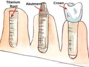 Dental Implant Process
