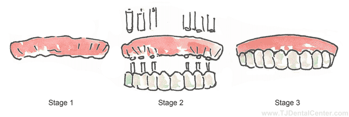 All-on-six Dental Implants